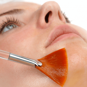 Chemical Peels