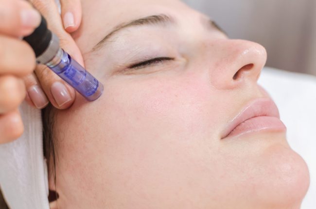 What does Micro-needling do for your face? How long does it take to heal from Micro-needling?