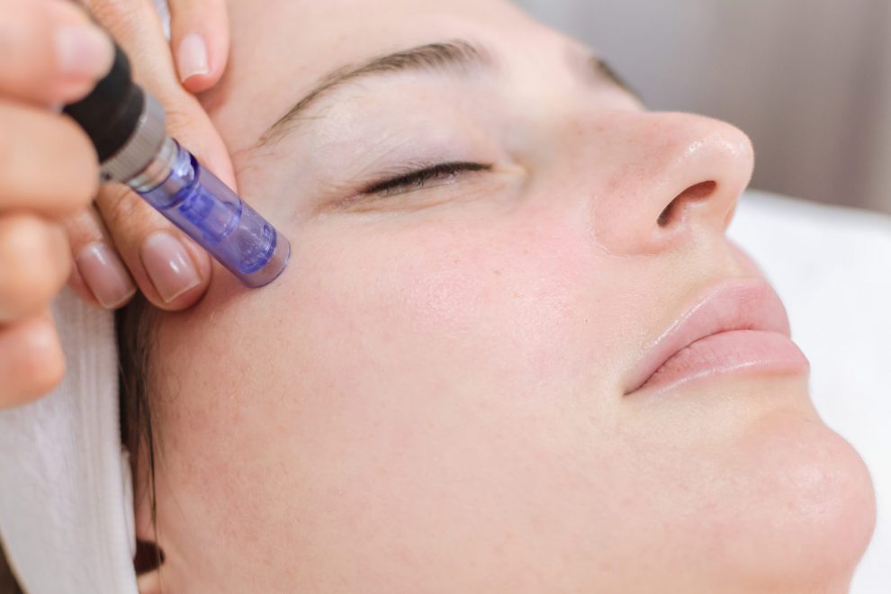 What does Micro-needling do for your face? How long does it take to heal from Micro-needling? What does Micro-needling do for your face? How long does it take to heal from Micro-needling?