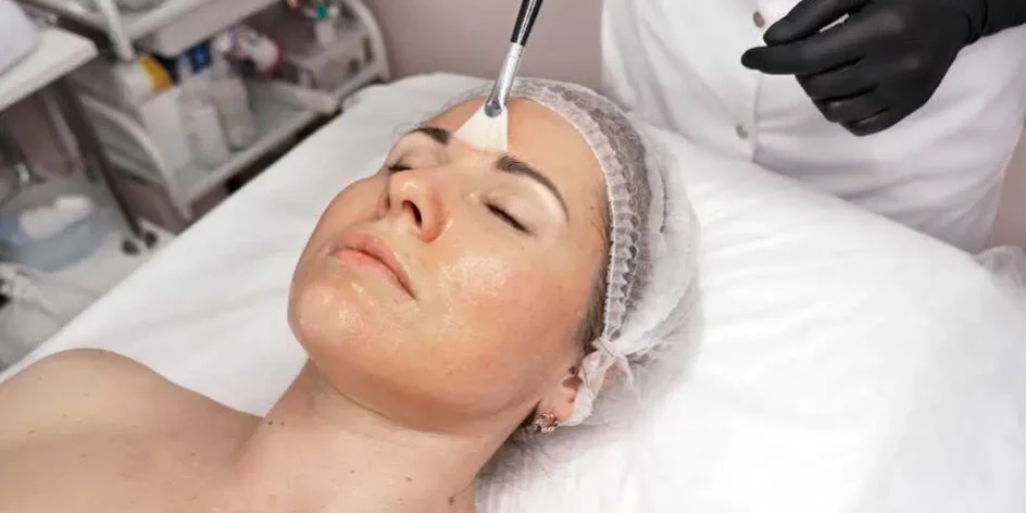 Chemical Peel Treatment in Greenville, SC by Alchemy West