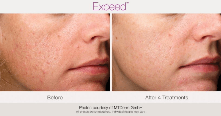 Microneedling Microneedling