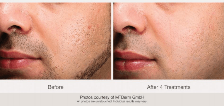 Microneedling Microneedling